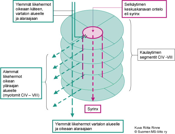 Selkäytimen tai aivorungon ontelotauti eli syringomyelia - Neuroliitto  Neuroliitto