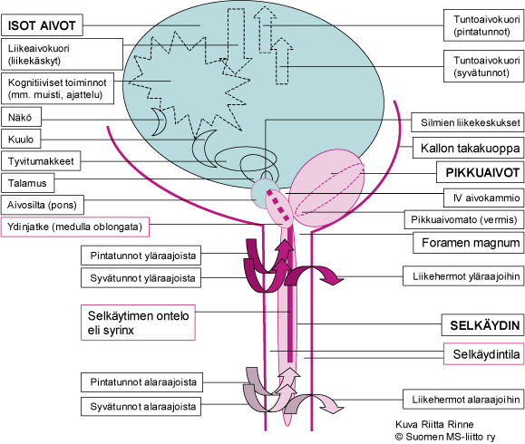 Selkäytimen tai aivorungon ontelotauti eli syringomyelia - Neuroliitto  Neuroliitto